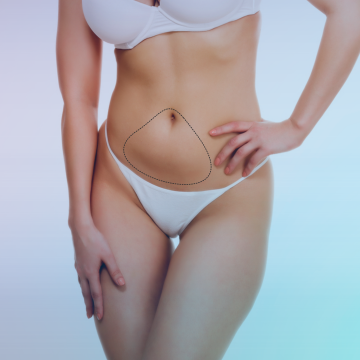 Abdominoplastia